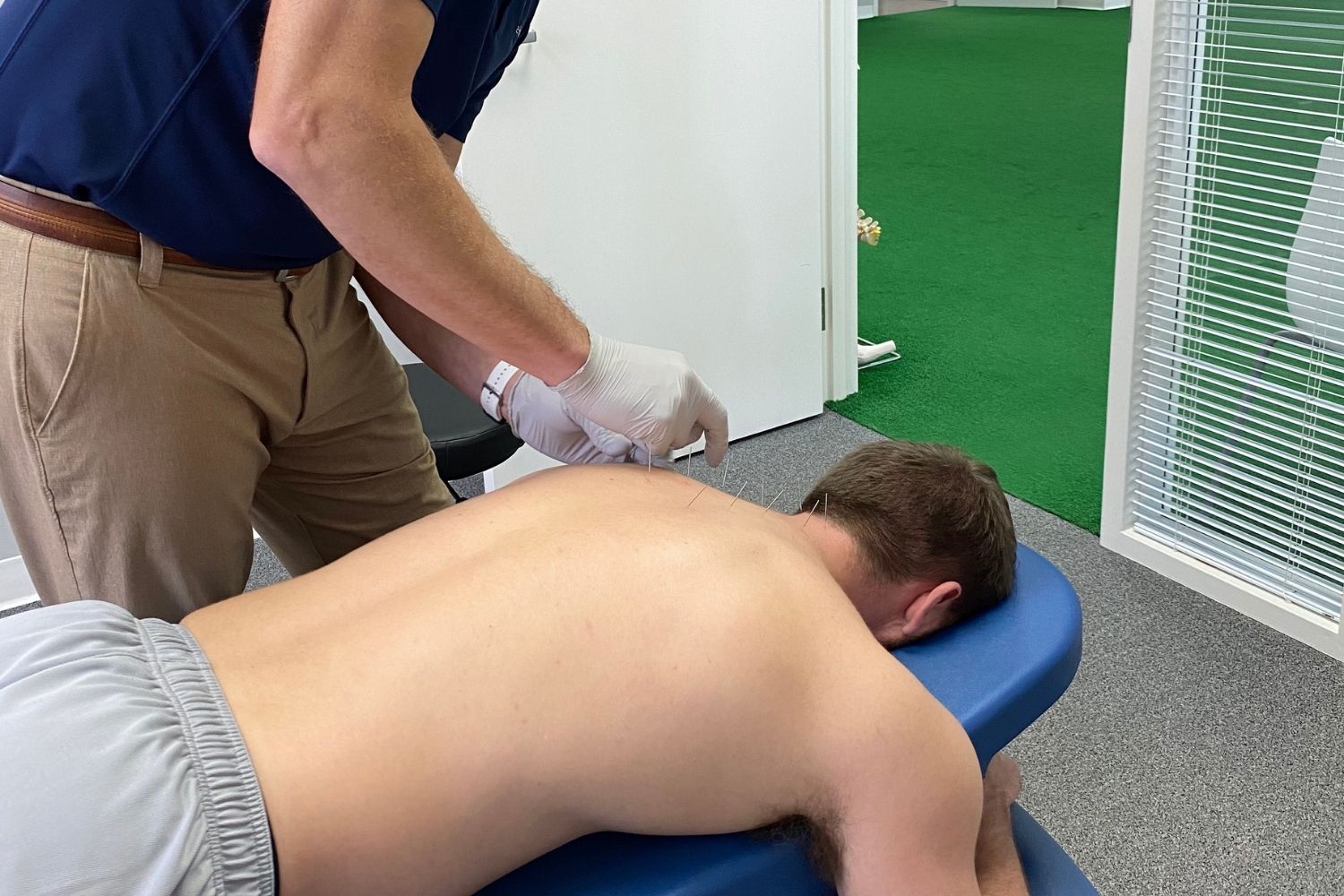 acupuncture picture