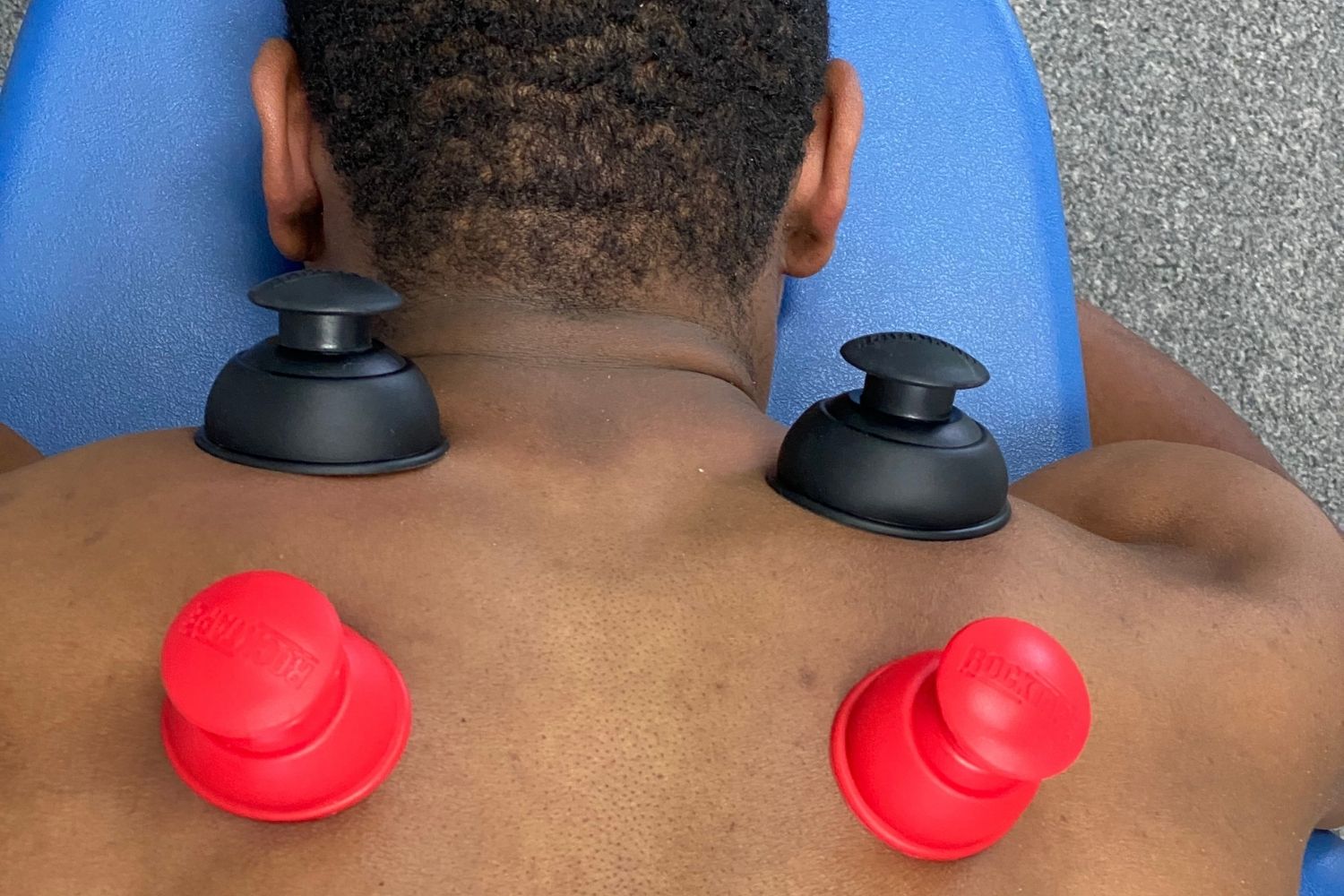 cupping picture